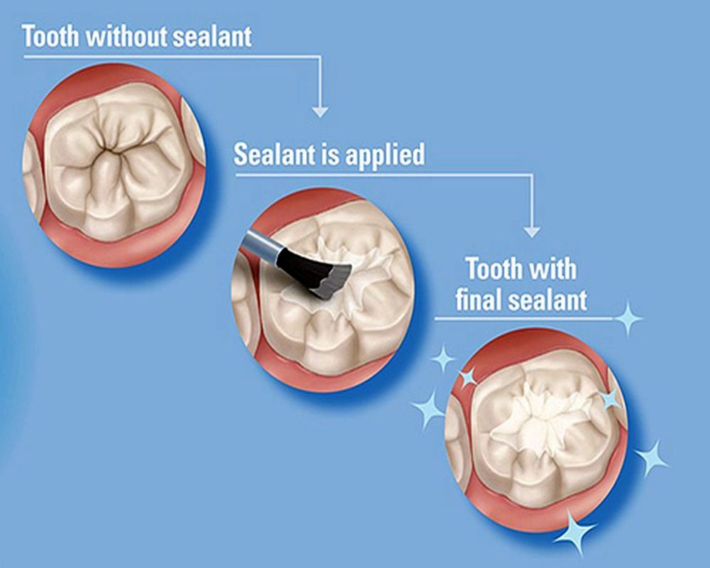 Dental-sealants